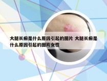 大腿长癣是什么原因引起的图片 大腿长癣是什么原因引起的图片女性