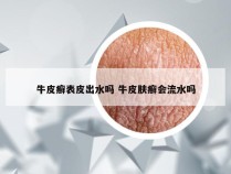 牛皮癣表皮出水吗 牛皮肤癣会流水吗