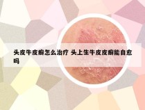 头皮牛皮癣怎么治疗 头上生牛皮皮癣能自愈吗