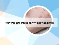 扶严宁是治牛皮癣吗 扶严宁治脚气效果怎样