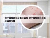 得了银屑病可以喝红酒吗 得了银屑病可以喝红酒吗女性