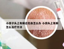 小孩子头上有癣还出血怎么办 小孩头上有癣怎么治疗方法