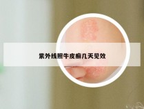 紫外线照牛皮癣几天见效