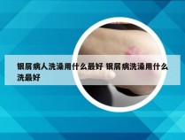 银屑病人洗澡用什么最好 银屑病洗澡用什么洗最好