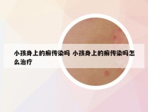 小孩身上的癣传染吗 小孩身上的癣传染吗怎么治疗