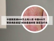 中国银屑病600万占用人楼 中国600万银屑病患者超7成曾遭遇歧视 基层治疗水