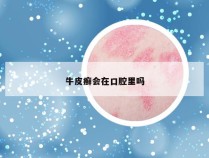 牛皮癣会在口腔里吗