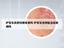 炉甘石洗剂对癣有用吗 炉甘石洗剂能治皮肤病吗