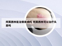 阿莫西林能治银屑病吗 阿莫西林可以治疗头屑吗