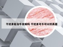 干扰素能治牛皮癣吗 干扰素可不可以抗真菌