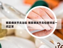 银屑病关节炎治验 银屑病关节炎检查项目一切正常