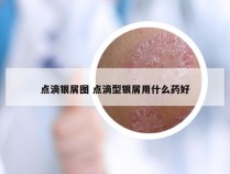 点滴银屑图 点滴型银屑用什么药好