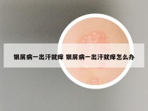 银屑病一出汗就痒 银屑病一出汗就痒怎么办