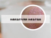 头癣的治疗与预防 头癣治疗指南