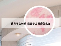 我鼻子上长癣 我鼻子上长癣怎么办