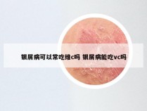 银屑病可以常吃维c吗 银屑病能吃vc吗