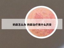 奶藓怎么办 奶藓治疗用什么药膏