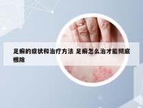 足癣的症状和治疗方法 足癣怎么治才能彻底根除