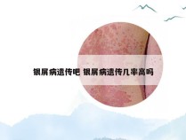 银屑病遗传吧 银屑病遗传几率高吗