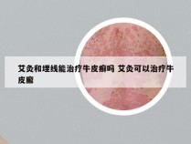 艾灸和埋线能治疗牛皮癣吗 艾灸可以治疗牛皮廨