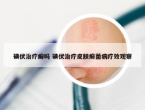 碘伏治疗癣吗 碘伏治疗皮肤癣菌病疗效观察