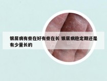 银屑病有些在好有些在长 银屑病稳定期还是有少量长的