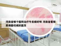 河南省哪个医院治疗牛皮癣好呀 河南省看银屑病最权威的医生