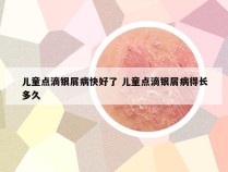 儿童点滴银屑病快好了 儿童点滴银屑病得长多久