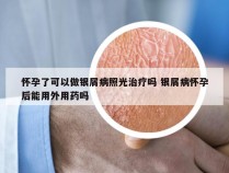 怀孕了可以做银屑病照光治疗吗 银屑病怀孕后能用外用药吗