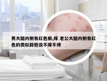 男大腿内侧有红色癣,痒 老公大腿内侧有红色的类似藓他说不痒不疼