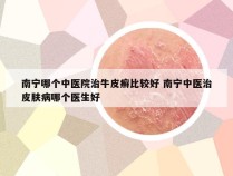 南宁哪个中医院治牛皮癣比较好 南宁中医治皮肤病哪个医生好