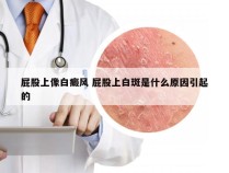 屁股上像白癜风 屁股上白斑是什么原因引起的