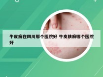 牛皮癣在四川那个医院好 牛皮肤癣哪个医院好