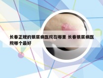 长春正规的银屑病医院在哪里 长春银屑病医院哪个最好