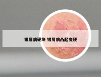 银屑病硬块 银屑病凸起变硬