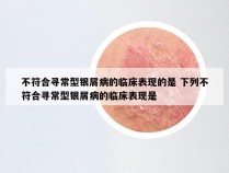 不符合寻常型银屑病的临床表现的是 下列不符合寻常型银屑病的临床表现是