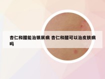 杏仁和醋能治银屑病 杏仁和醋可以治皮肤病吗