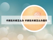 手腕处长癣怎么办 手腕处长癣怎么办图片