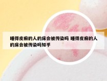 睡得皮癣的人的床会被传染吗 睡得皮癣的人的床会被传染吗知乎