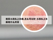 我家小孩头上长癣,怎么可以好 小孩头上长癣用什么药膏