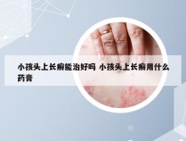 小孩头上长癣能治好吗 小孩头上长癣用什么药膏