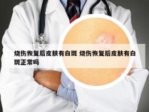 烧伤恢复后皮肤有白斑 烧伤恢复后皮肤有白斑正常吗