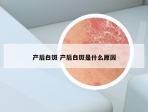 产后白斑 产后白斑是什么原因