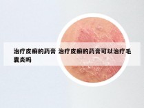 治疗皮癣的药膏 治疗皮癣的药膏可以治疗毛囊炎吗