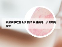 银屑病多吃什么食物好 银屑病吃什么食物好得快