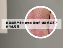 银屑病很严重对身体有影响吗 银屑病厉害了有什么后果