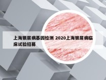 上海银屑病基因检测 2020上海银屑病临床试验招募