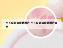 小儿白斑病症状图片 小儿白斑病症状图片大全