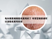 龟头银屑病用他克莫司好了 寻常型银屑病可以涂他克莫司软膏