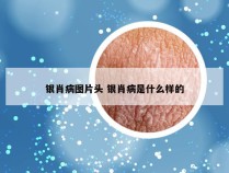 银肖病图片头 银肖病是什么样的